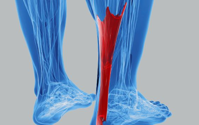 Achilles Tendinopathy